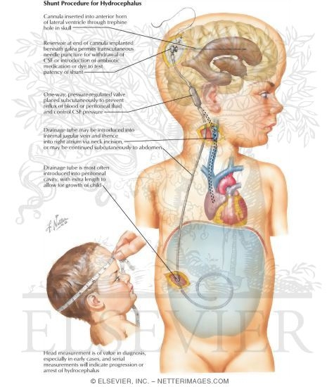 Shunt Procedure for Hydrocephalus