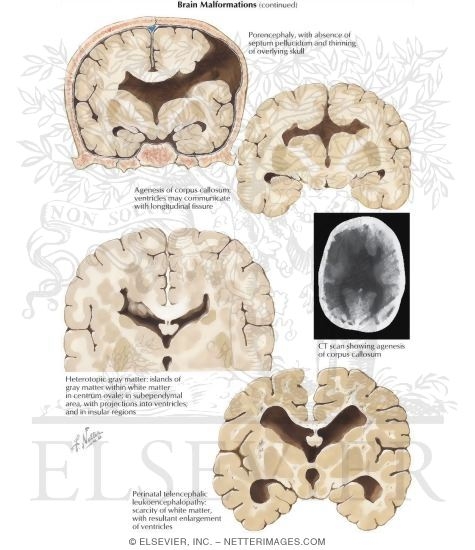 Watermarked preview of labeled image: Brain Malformations