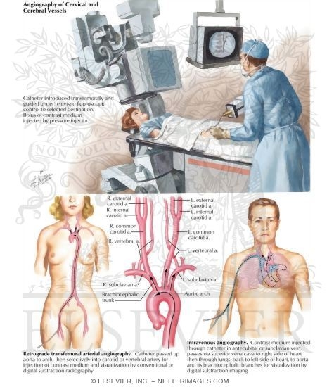 Angiography of Cervical and Cerebral Vessels