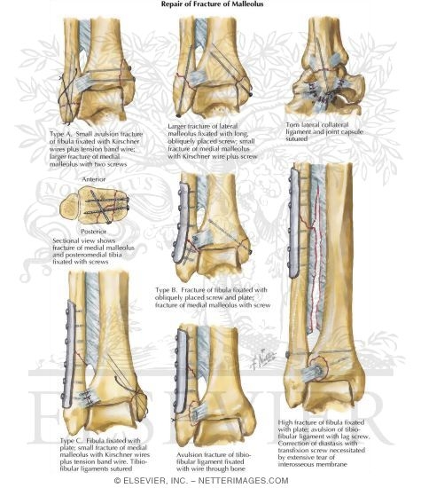 Watermarked preview of labeled image: Repair of Fracture of Malleolus
