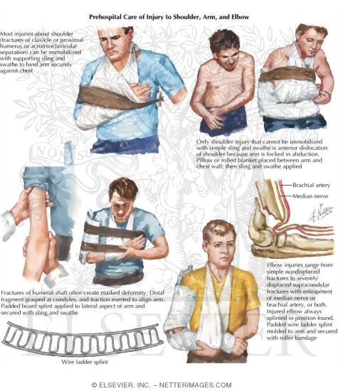Watermarked preview of labeled image: Prehospital Care of Injury to Shoulder, Arm, and Elbow