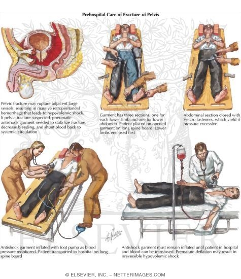 Watermarked preview of labeled image: Prehospital Care of Fracture of Pelvis