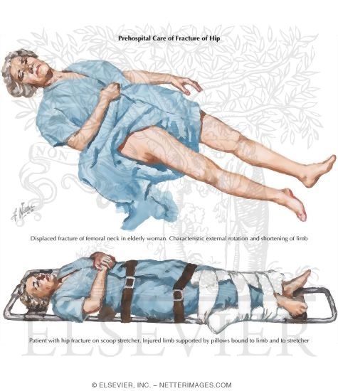 Watermarked preview of labeled image: Prehospital Care of Fracture of Hip