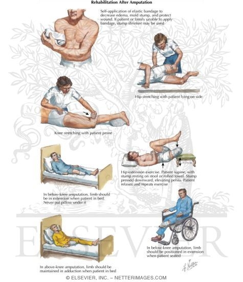 Rehabilitation After Amputation