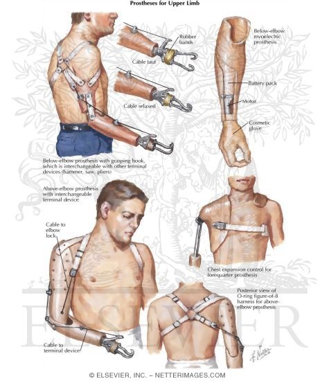 Watermarked preview of labeled image: Prostheses for Upper Limb