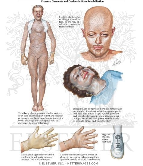 Pressure Garments and Devices in Burn Rehabilitation