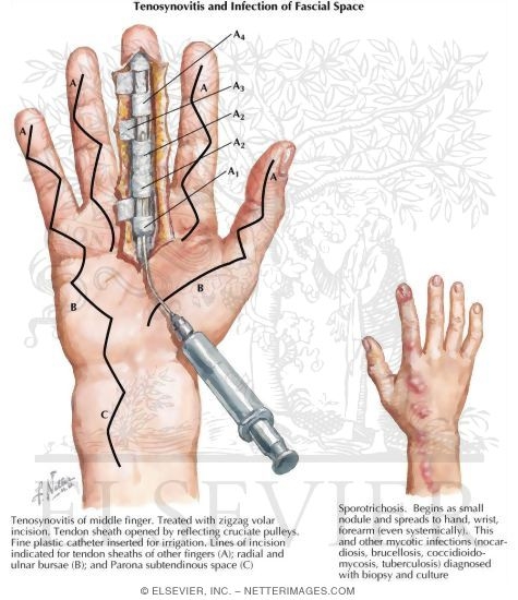 Brunner incision hand 2025