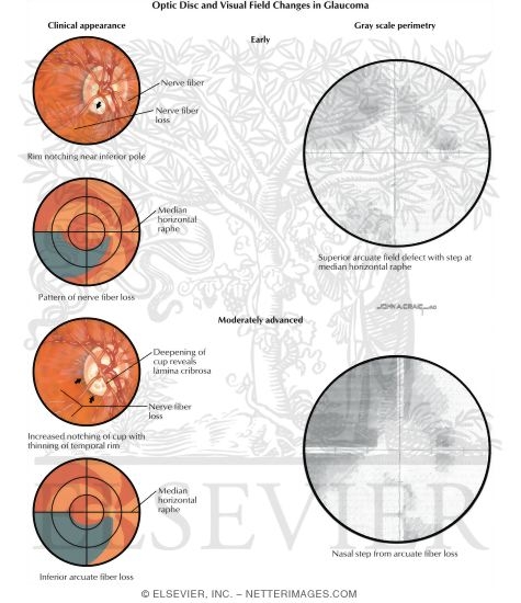 Watermarked preview of labeled image: Optic Disc and Visual Field Changes In Glaucoma