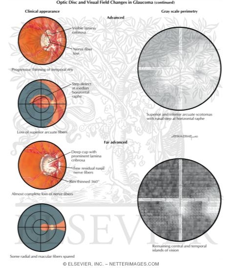 Watermarked preview of labeled image: Optic Disc and Visual Field Changes In Glaucoma
