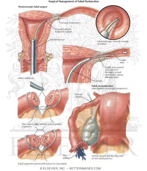 Surgical Management of Tubal Factor Infertility