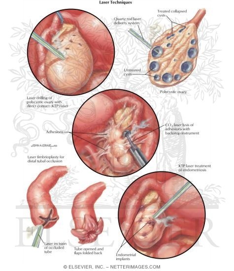 Watermarked preview of labeled image: Laser Techniques In Infertility