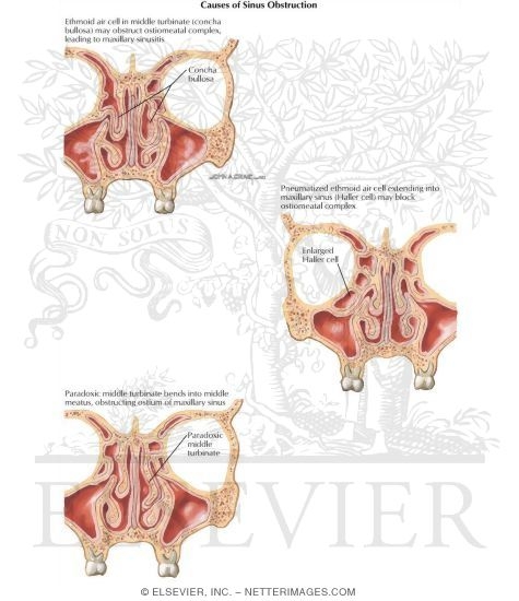 Watermarked preview of labeled image: Anatomic Causes of Ostiofatal Obstruction