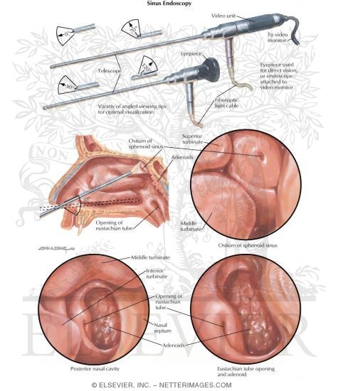 Nasal Endoscopy