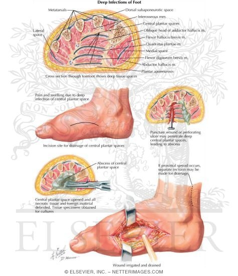Deep Infections of Foot