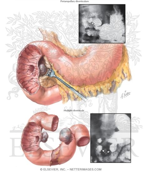 Watermarked preview of unlabeled image: Diverticula of the Duodenum