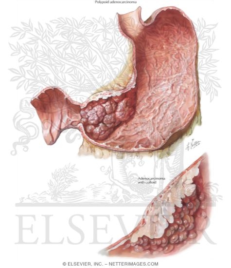 Watermarked preview of labeled image: Carcinoma of Stomach