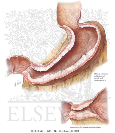 Watermarked preview of labeled image: Carcinoma of Stomach