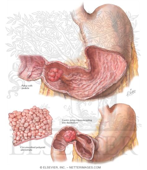 Benign Tumors of Stomach