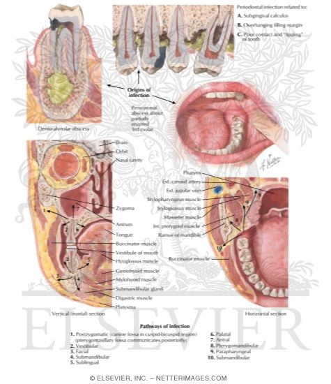 Odontogenic Infections - Their Spread and Abscess Formation