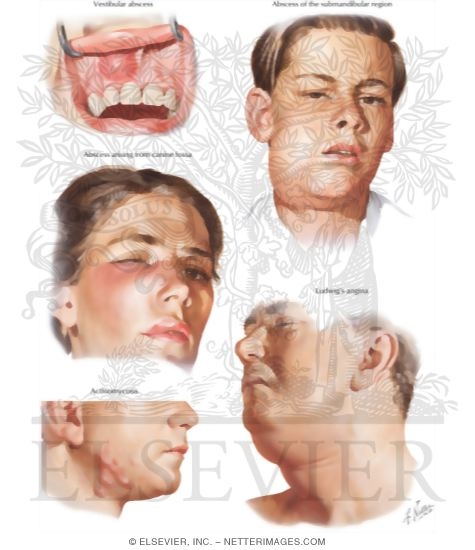 Watermarked preview of labeled image: Odontogenic Infections - Their Spread and Abscess Formation