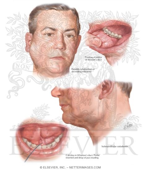 Watermarked preview of labeled image: Inflammations of Salivary Glands