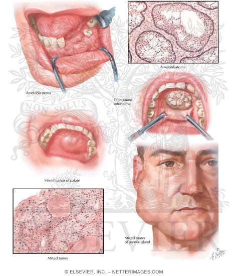 Benign Tumors of Oral Cavity
