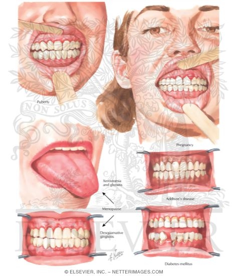 Watermarked preview of labeled image: Oral Manifestations Related to Endocrine System
Gingivitis in Pregnancy