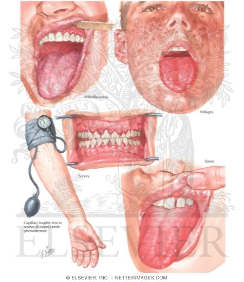Oral Manifestations In Nutritional Deficiencies