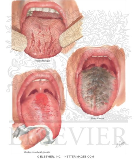 Watermarked preview of labeled image: Manifestations of Tongue