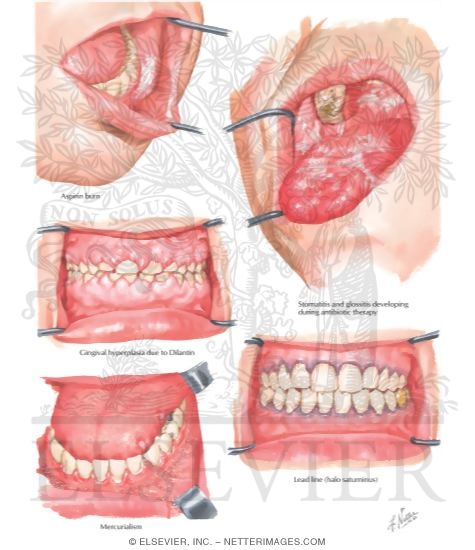 Watermarked preview of labeled image: Effects of Chemical Agents on Oral Mucosa