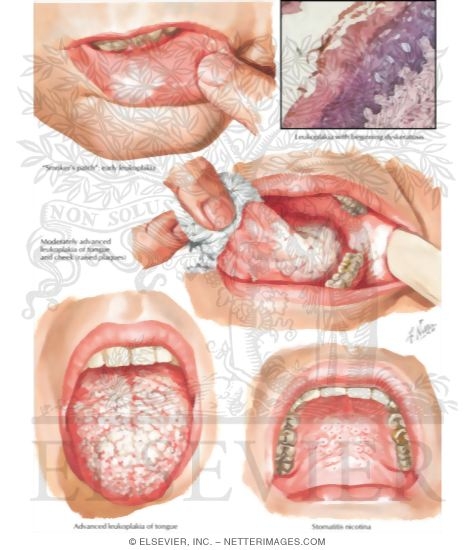 Watermarked preview of labeled image: Leukoplakia