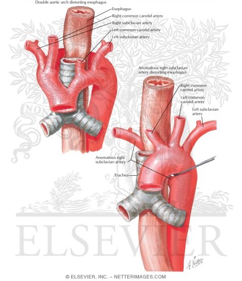 Double Aortic Arch, Dysphagia Lusoria