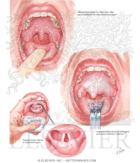 Allergic Conditions of Pharynx