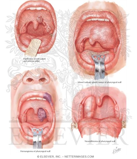 Benign Tumors of Fauces and Oral Pharynx