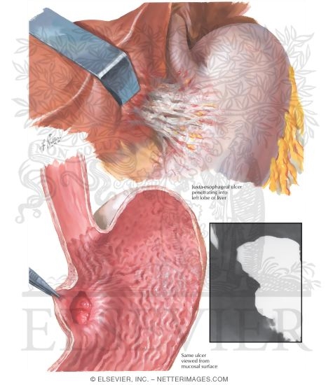 Watermarked preview of labeled image: Peptic Ulcer IV - Ulcer Near Cardia