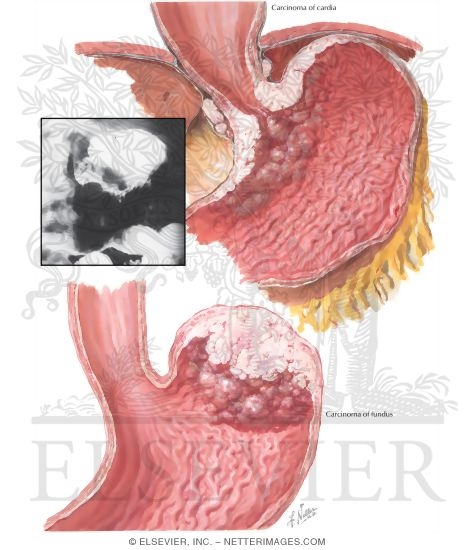 Watermarked preview of labeled image: Carcinoma of Stomach