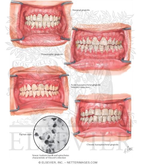 Gingivitis
