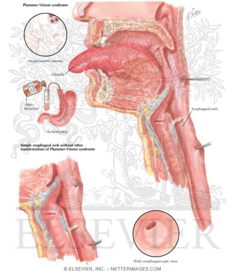 Plummer-Vinson Syndrome