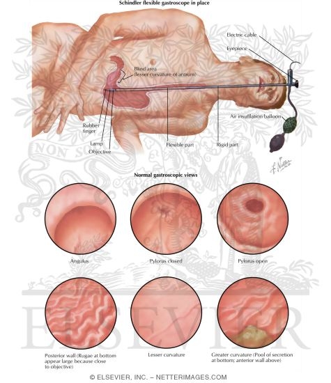Gastroscopy