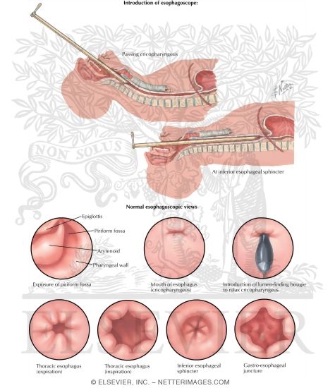 Esophagoscopy