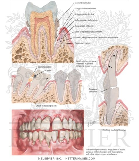 Watermarked preview of labeled image: Periodontal Disease