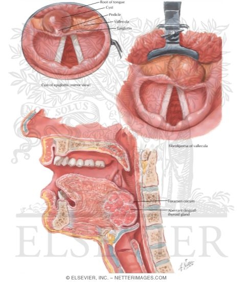 Watermarked preview of labeled image: Benign Tumors of Vallecula and Root of Tongue