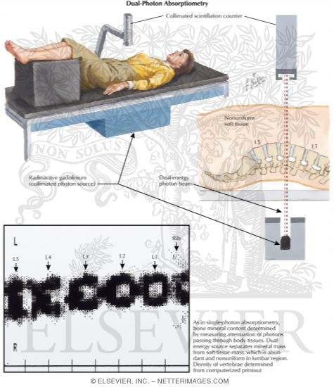 Watermarked preview of labeled image: Dual-Photon Absorptiometry
Diagnostic Imaging Techniques