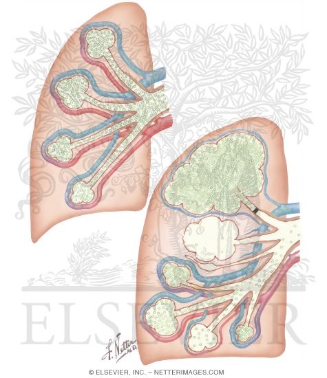 Carbon Dioxide Exchange In Normal and Emphysematous Lungs