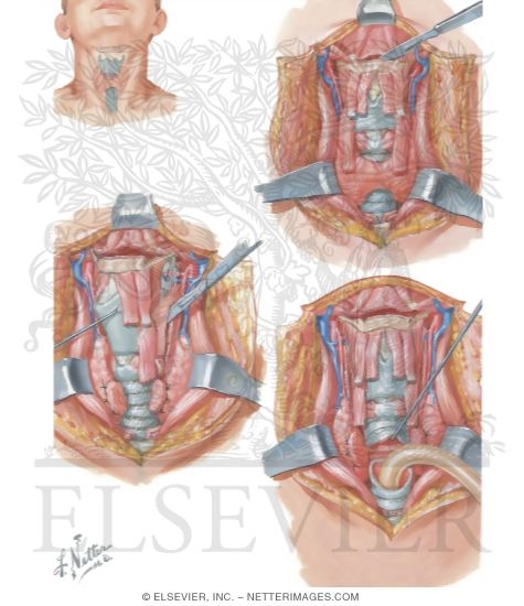 Watermarked preview of unlabeled image: Total Laryngectomy
