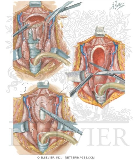 Total Laryngectomy