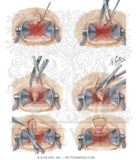 Anal Crypt: Hypertrophied Papilla