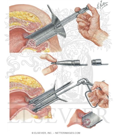 Internal Hemorrhoids: Injection and Ligature