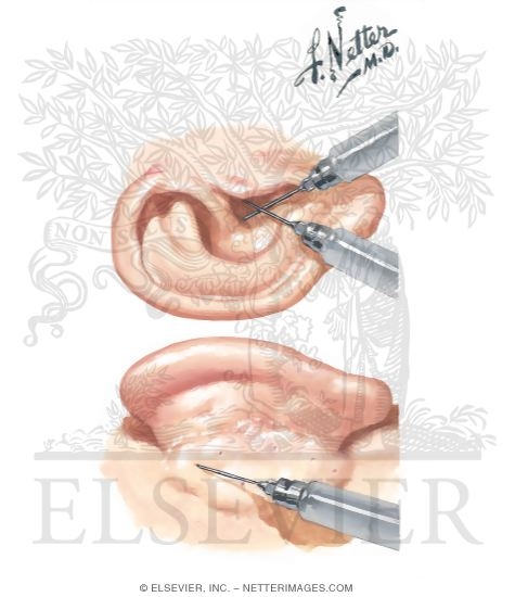 Watermarked preview of unlabeled image: Ultrasonic Destruction of Vestibular Labyrinth