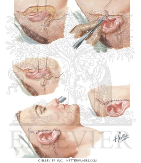 Facial Rhytidectomy 115